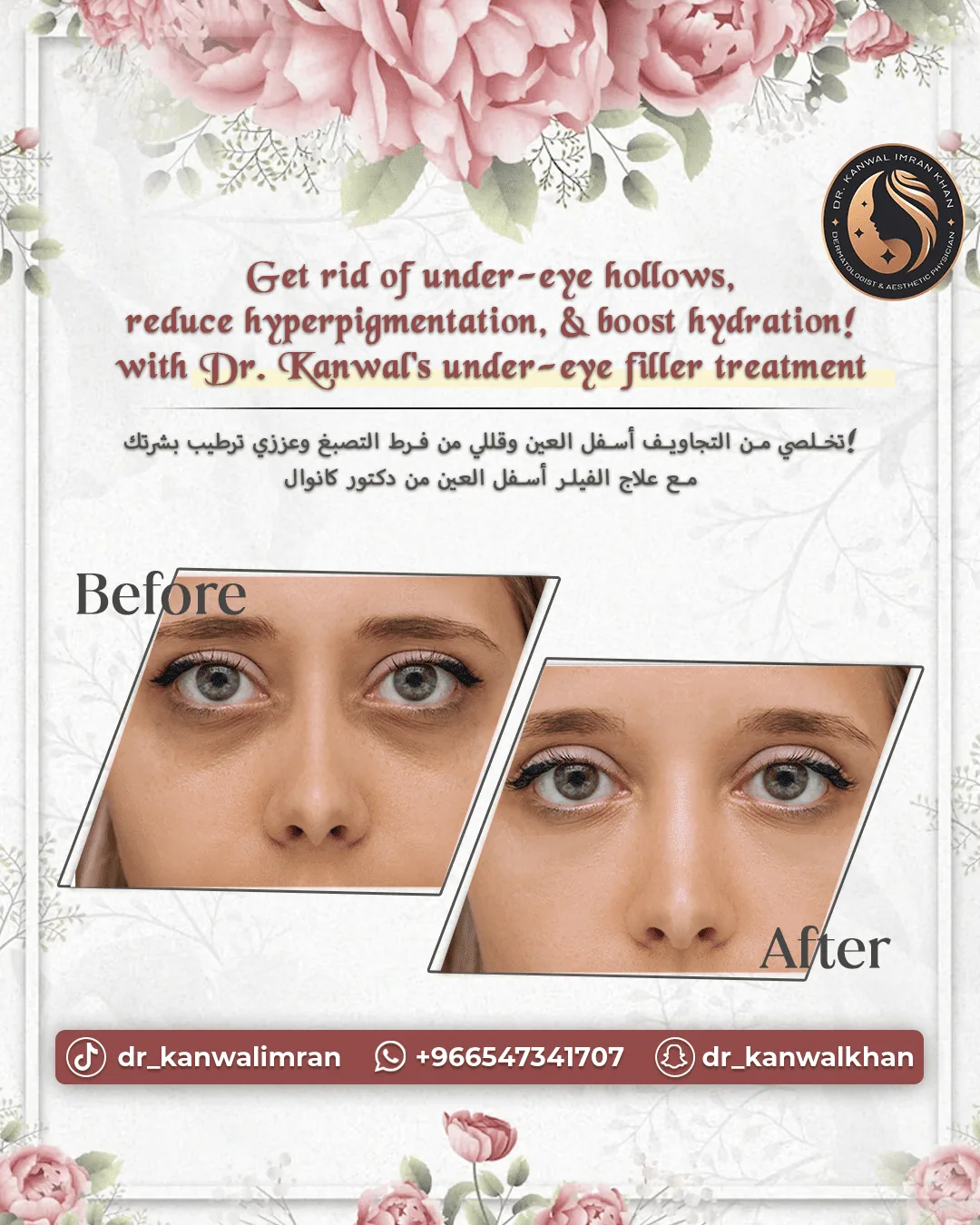 Under Eyes Fillers Treatment1
