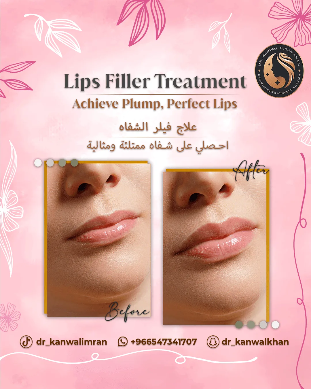 Lip Filler1